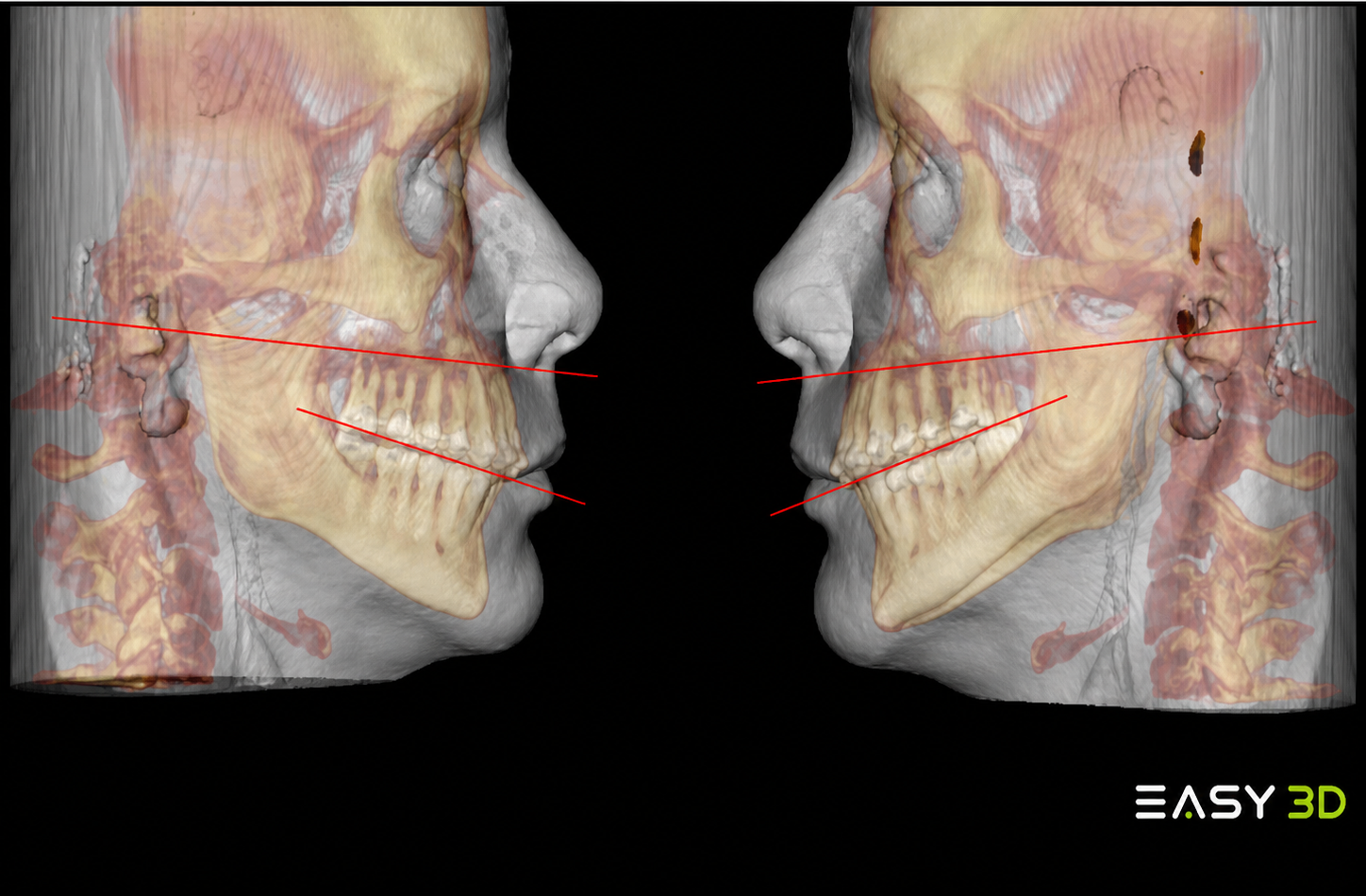Plano de Camper y plano oclusal en estudio 3D