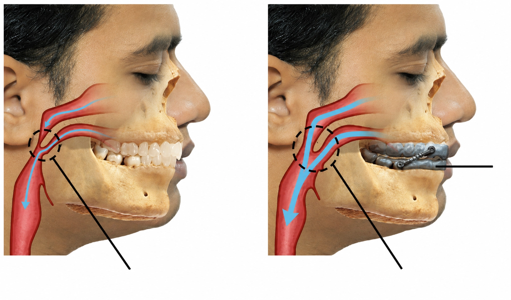 Medical comparison of airway before and after using a mandibular advancement device