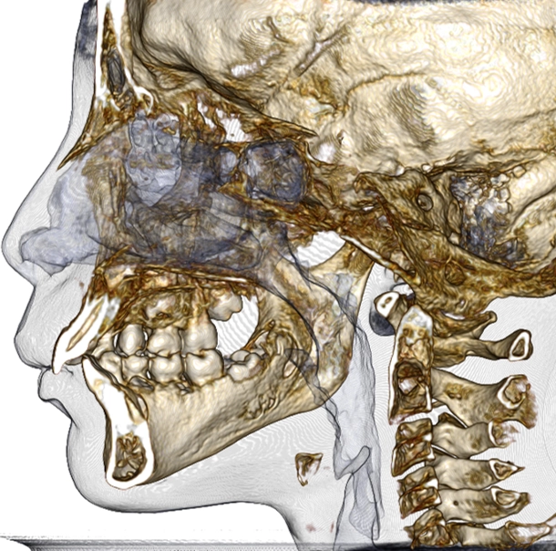 Craniometric study showing airway and craniofacial structures