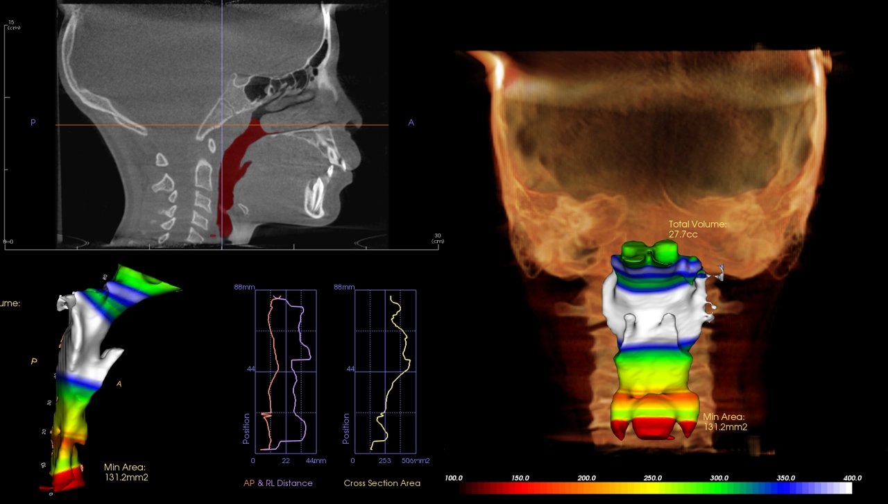 CBCT pharyngeal volume evaluation showing airway analysis